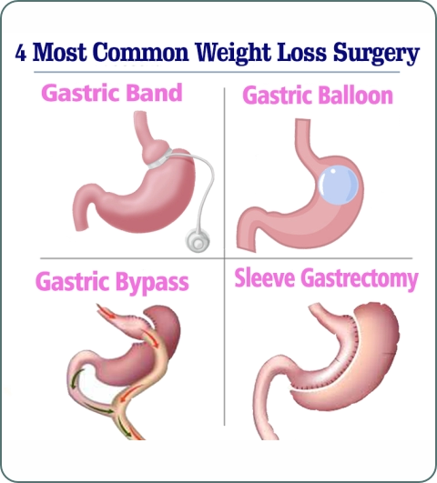 Bariatrics treatments and procedures imagery
